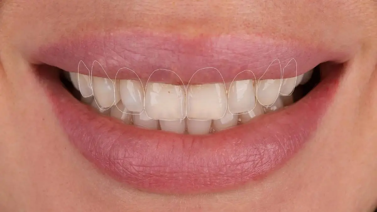 digital smile design 